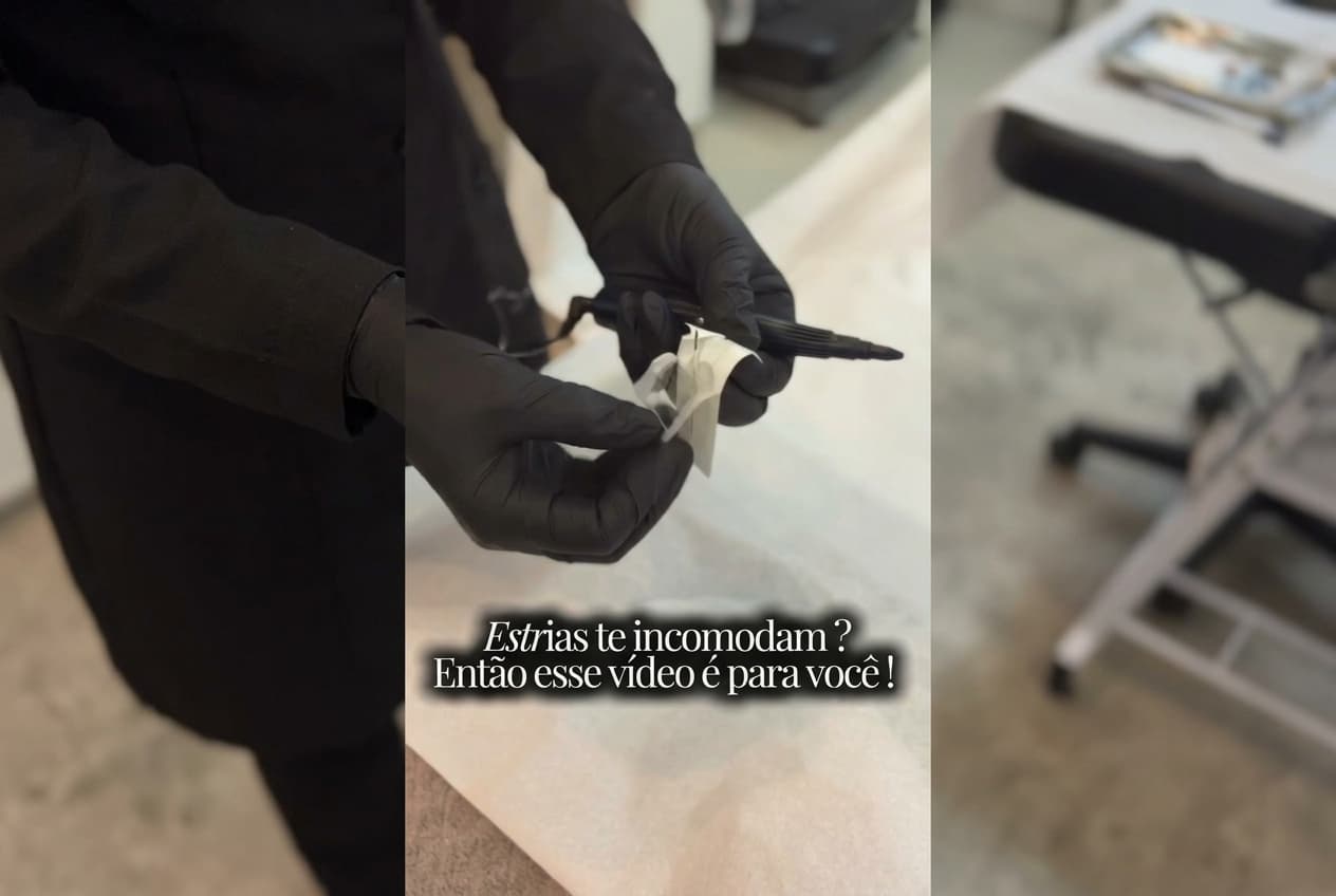 Clínica Santa Clara: Tratamento para Estrias com Qualidade, Resultado e Segurança.